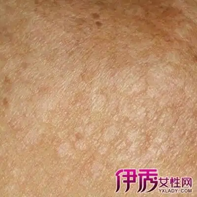 【图】婴儿汗斑图片大全欣赏 2种治疗方法教你快速去除汗斑