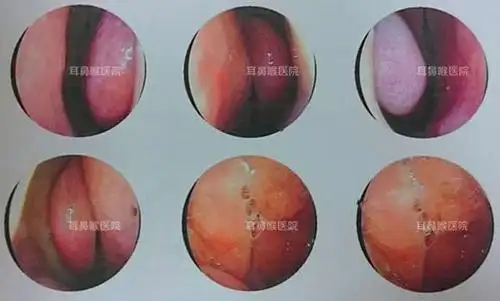 检查:通过德国wolf内窥镜对万女士的鼻部进行检查,结果发现她的双侧鼻