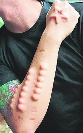 皮下植入小珠子当然,同样你也可以用盲文植入的方式,在皮下植入一些不