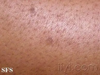 临床少见角化性皮肤病