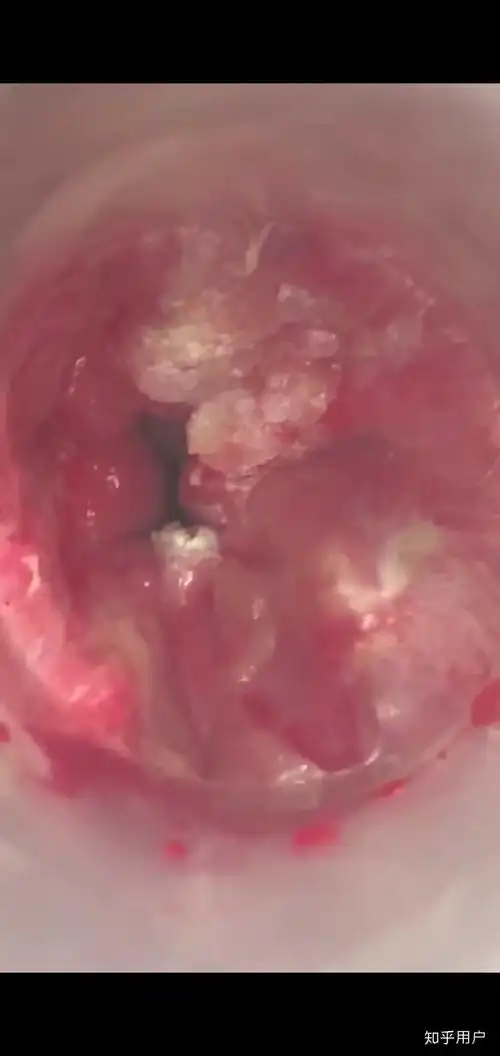 有没有肛内尖锐湿疣治愈的朋友哪种疗法更有效控制复发