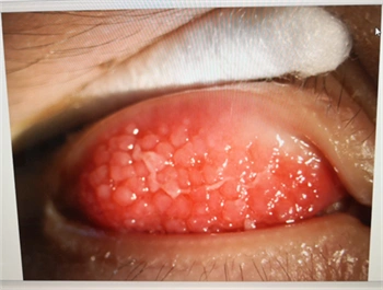 一,视力下降,12岁小孩疑似有圆锥角膜