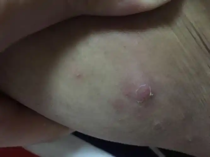 大腿内侧长脓包,挤过一次,有脓,周围有好几个小的.