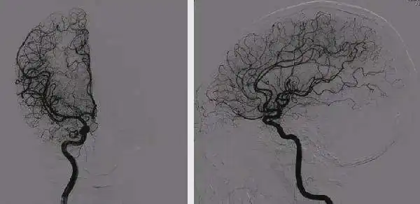 血管造影——脑血管成像的"金标准"