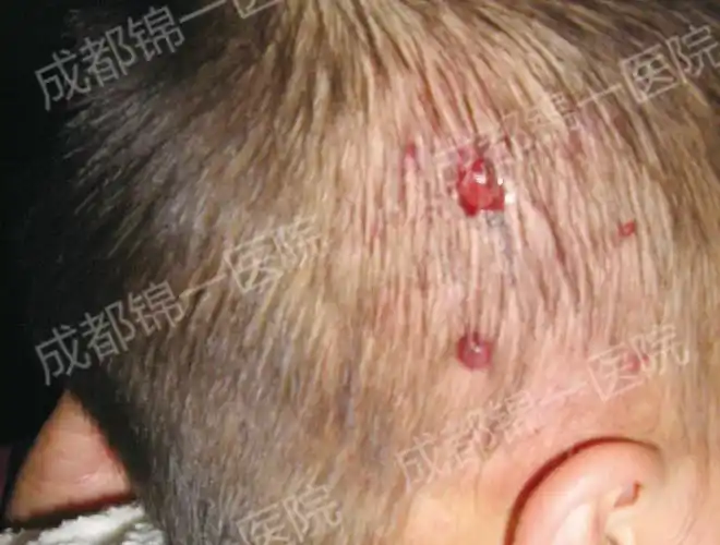 头部血管瘤可以不治疗吗-治疗方法-成都西部中西医结合医院