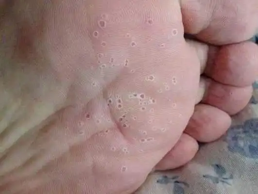 足藓初期症状图片 (22)_有来医生