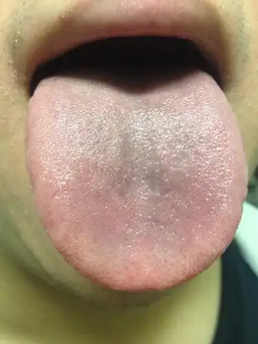 请中医帮我看看舌头 怎么会有点发青 谢谢了