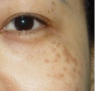 主页 褐色胎记 常识      褐青色痣(真皮斑)是一种先天性非遗传性的