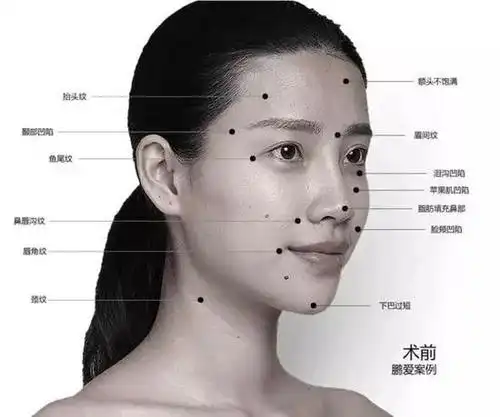 脸部填充_面部填充整形