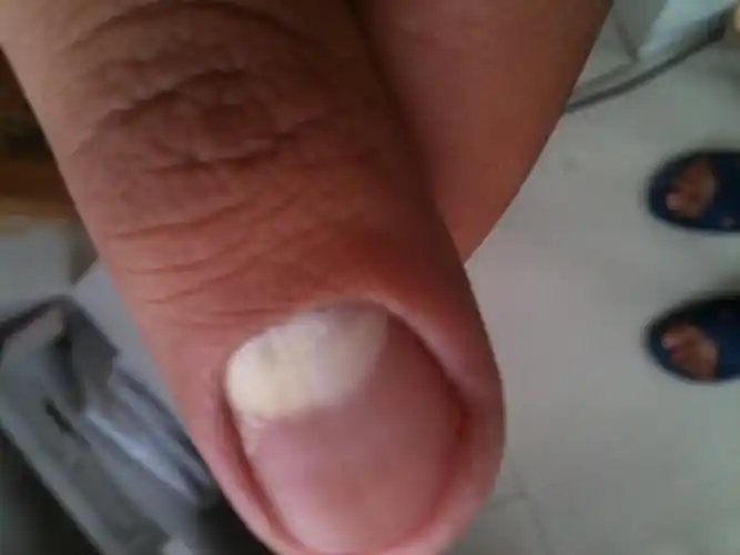 这个指甲月牙的地方发白,而且越来越多.怎么回事