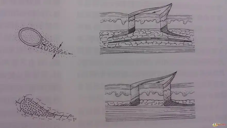 常见局部皮瓣图解