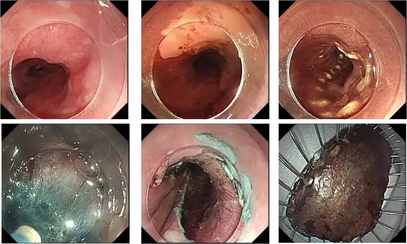 esd治疗食管早期癌(食管早癌)_食道癌_食道癌治疗方式 - 好大夫在线