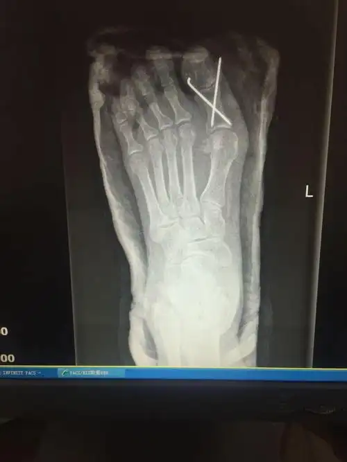 趾骨骨折经典案例
