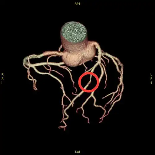 冠状动脉cta你了解吗