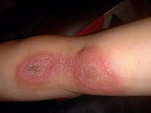 手臂皮肤发红 然后开始化脓 中心发黑