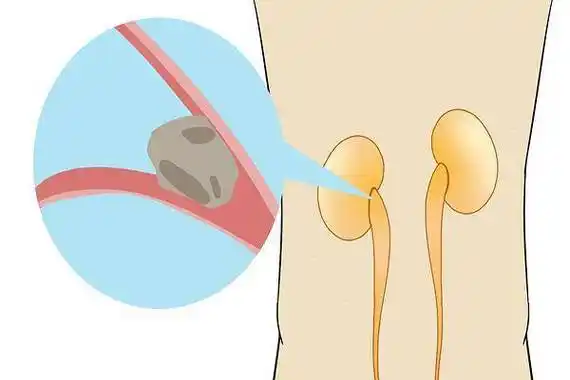 大爷喝出肾积水,他的错误,很多人或