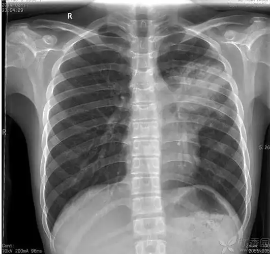 于2014-02-27拍胸片,诊断为大叶性肺炎; 在当地诊所抗炎治疗,10天左右