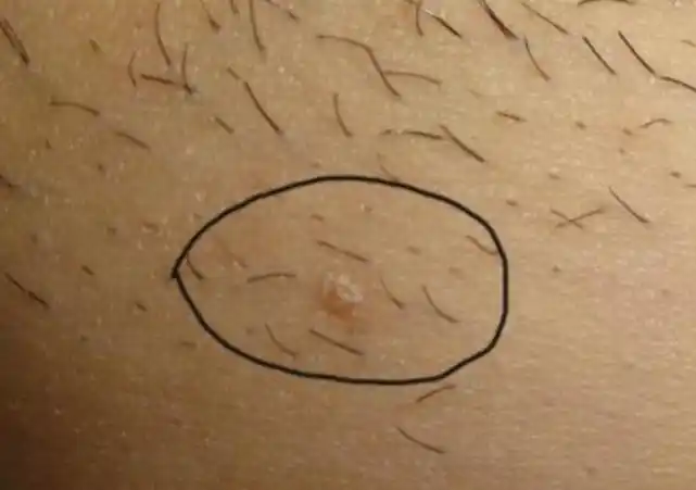 20岁女大学生下身长满"菜花",医生:大多数女生会出现,单身也不例外