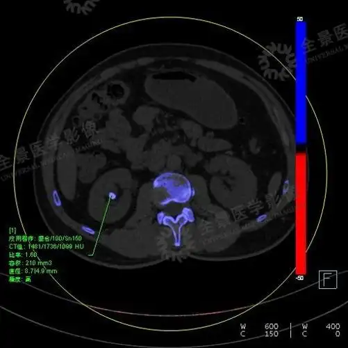 双能量ct可将尿酸结石和其他类型的肾结石区分开来:后处理结果会显示