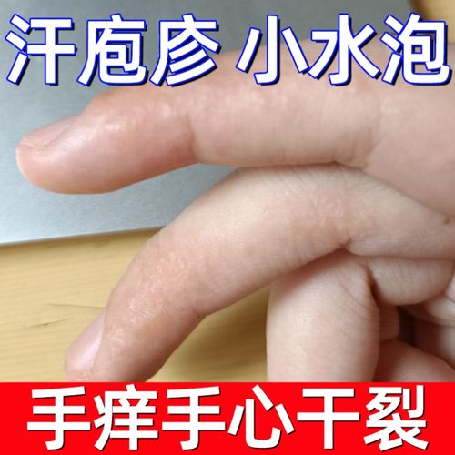 手上起小水泡汗状疱疹止痒克星鹅掌风特效药专治手脱皮起疱疹药膏