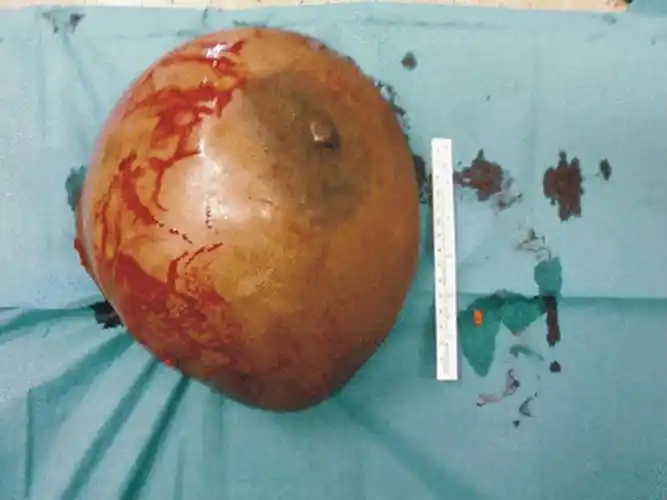 乳腺癌乳房切除后图片