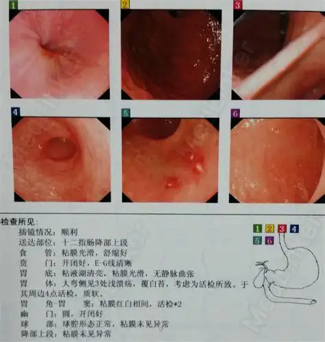 急性胃溃疡伴出血胃溃疡出血黑便自愈吗2022已更新今日资讯