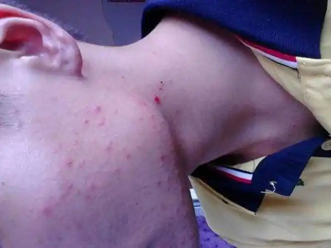 螨虫过敏症状引发结膜炎图片