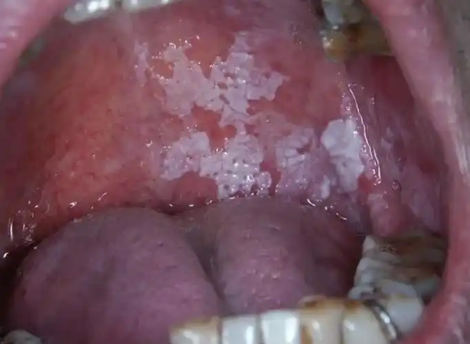 守护口腔健康,警惕口腔白斑