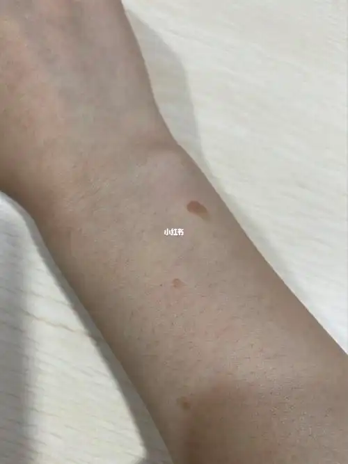 求解手上的长了点这种肉痣不知道是啥