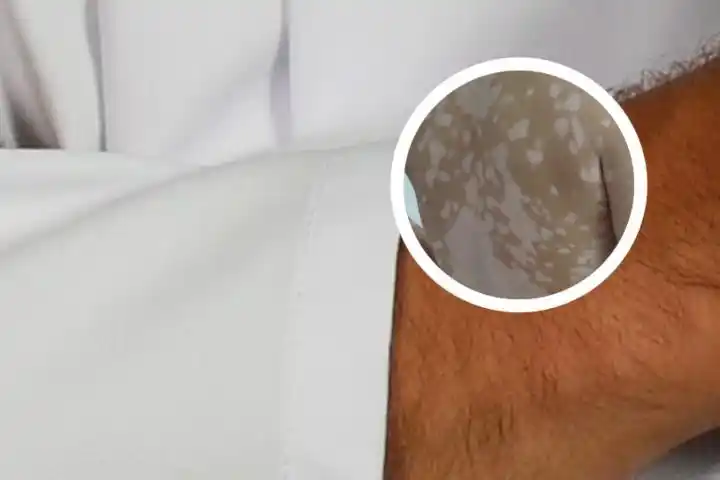 维生素e乳对身上白色斑点有抑制作用吗_求医网