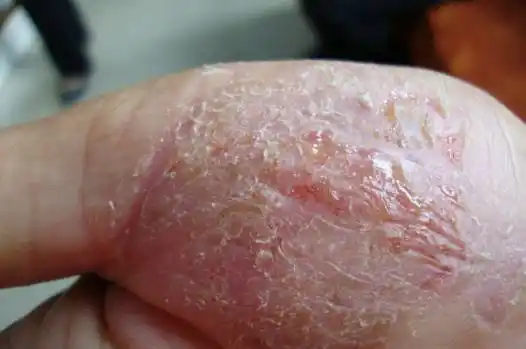 女孩天天洗澡竟四肢长出鱼鳞冬天洗澡的禁忌你中招没