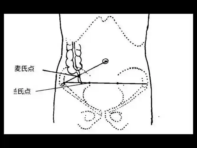 急性阑尾炎一点通ppt课件ppt