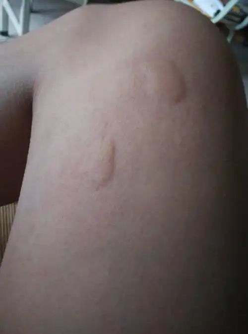 小小虫子咬出2至5的厘米的包,我去田里的插秧肯定被咬出大包,其他人