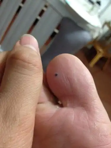 脚上长了个黑色的点点走起路来碰到就会疼