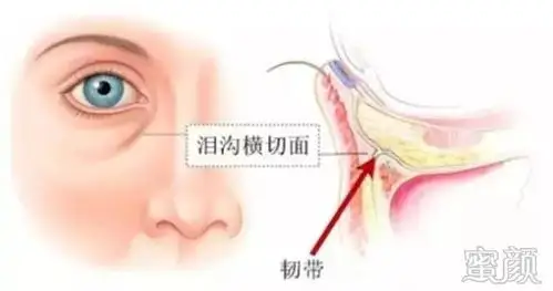 泪沟让人憔悴自体脂肪或填充玻尿酸消除泪痕沟