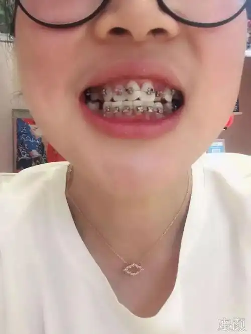 矫正                     矫正时长:596天     拔牙