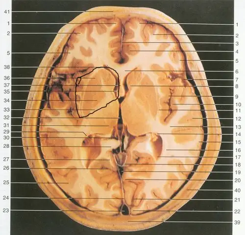 "基底节区"的准确定义是什么?求助!
