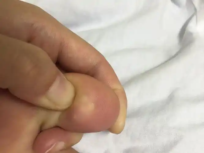 脚趾头下长了三个个小疙瘩 不痛不痒需要治疗吗?