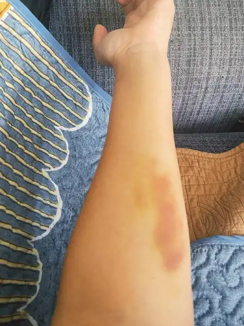 刚才突然发现胳膊有一片淤血