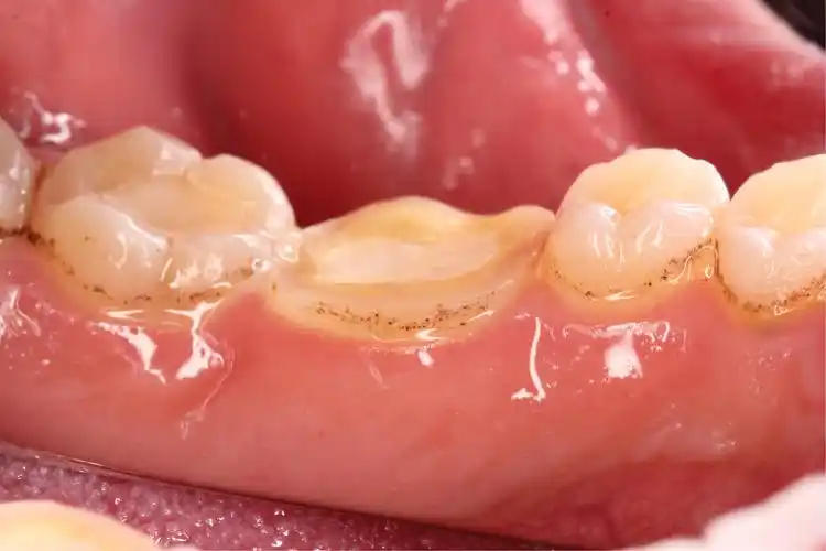 崔发46 根管治疗 高嵌体