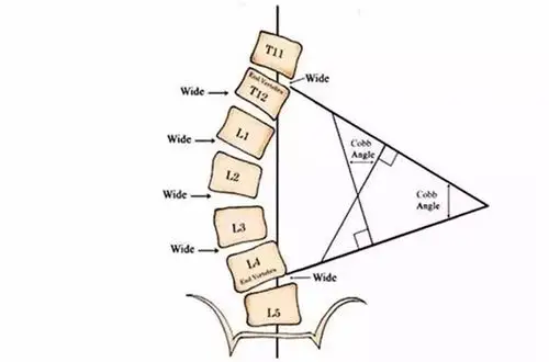 驼背,高低肩,歪脖子,用我的方法查查有没有脊柱侧弯