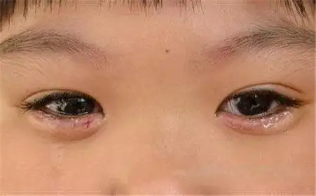 什么是睑内翻倒睫