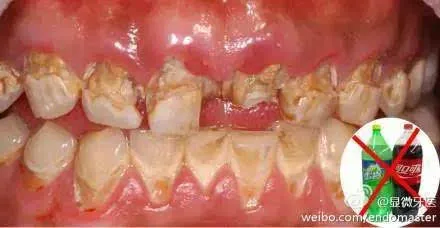 5岁宝宝变老头你还敢给孩子喝可乐吗