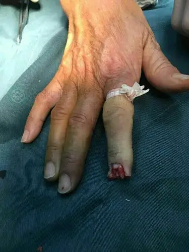 【2017年5月23日】女,49岁,右示指末节部分毁损伤清创探查v—y推进