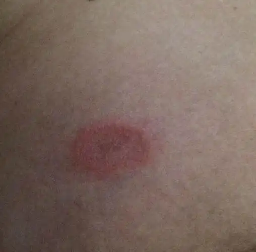 乳房上起红疙瘩,不痛很痒,大约指甲大小.