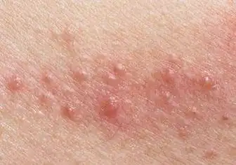 高危hpv感染,需做详细检查后再考虑观察