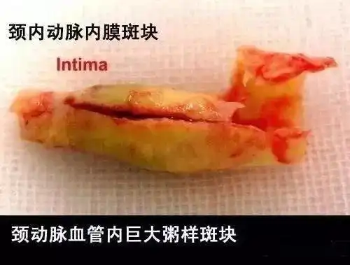 此外,超过30种不同的微生物dna在粥样硬化斑块的dna中分离出来.