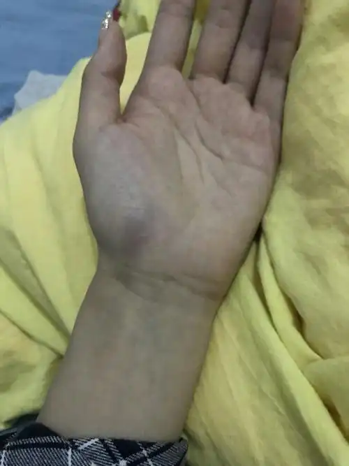 手掌人鱼线突然青了疼 也没碰 突然之间就青了 一按就疼