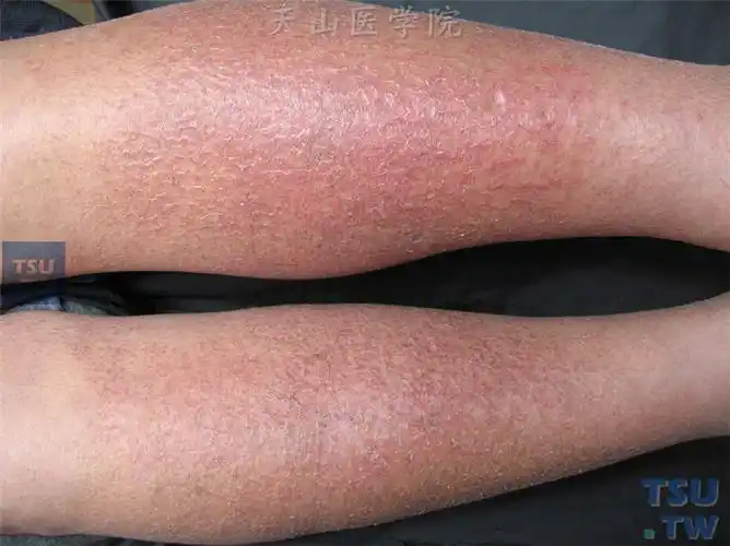 湿疹(eczema)的症状表现