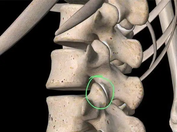 真假李逵腰椎间盘突出症中的李鬼你遇见几个